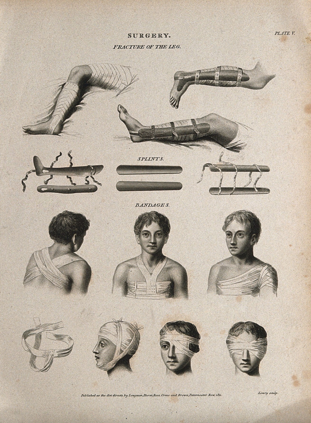 Ein medizinisches Illustration aus dem 19. Jahrhundert, das die Beine eines Mannes und den Kopf einer Frau zeigt, beide mit Verband um den Kopf, begleitet von erklärendem Text.